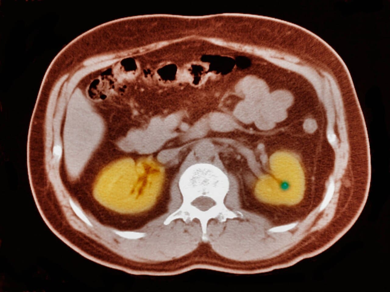 Tomografia de abdome, corte axial