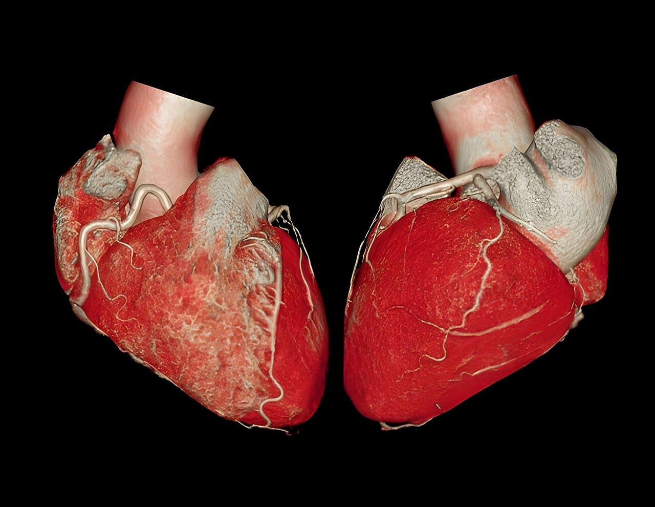 Angiotomografia, reconstrução 3D do coração e coronárias