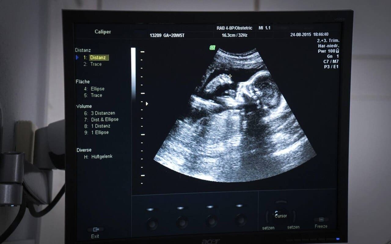 Ultrassom obstétrico, imagem do bebê no monitor